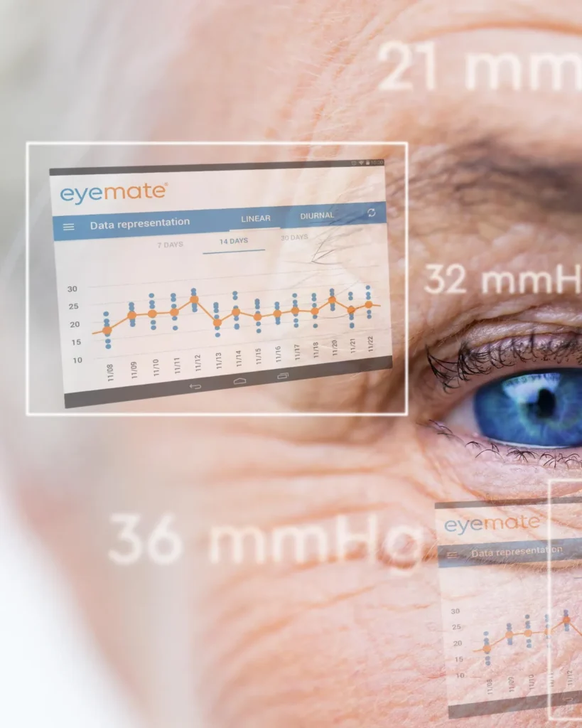 Grafische Darstellung eines Auges mit überlagertem Datendiagramm zur Visualisierung der kontinuierlichen Augeninnendruck-Messung durch eyemate.